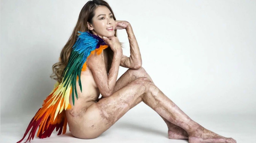 Tiene el 91% del cuerpo quemado y posó para una impactante sesión de fotos | Redes