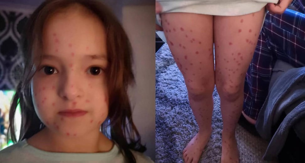 Nena se pinto puntitos rojos para fingir que tenía varicela y faltar al colegio: pero la trampa le salió mal | Curiosidades