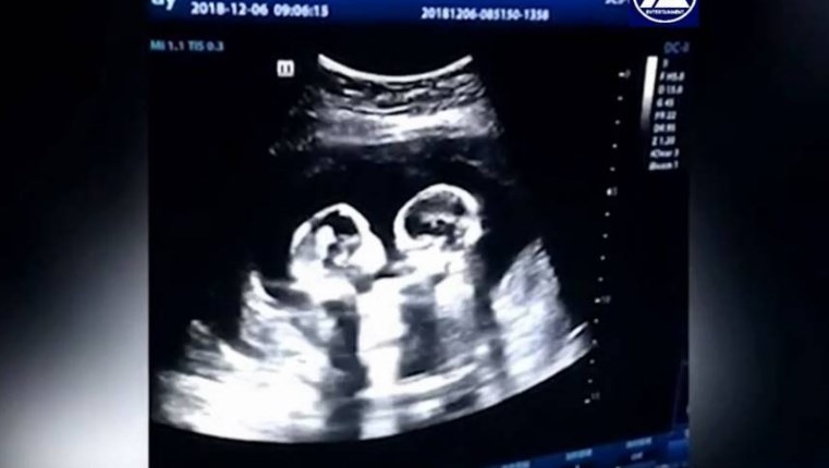 Video: la pelea entre gemelas en el útero de su madre | Curiosidades