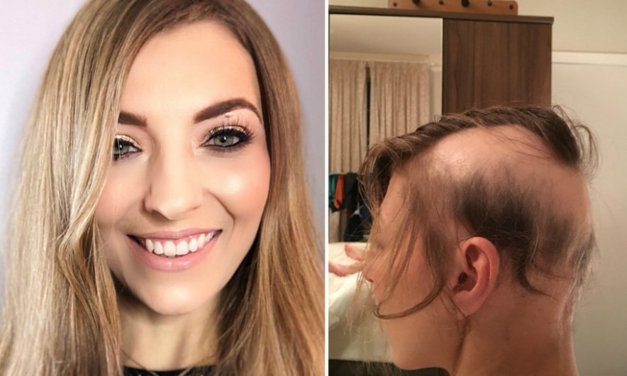 La mujer que se quedó pelada por el estrés que le causó su casamiento | Curiosidades