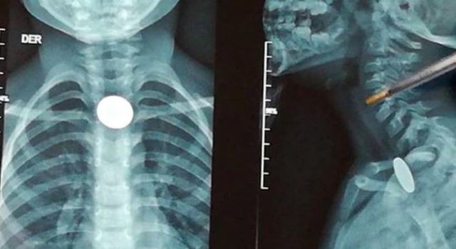 Un nene lleva 7 días atragantado con una moneda y no autorizan su extracción | Curiosidades