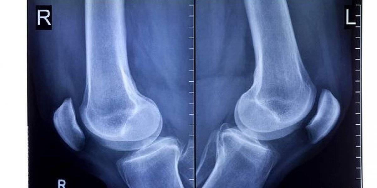 "Fabela", el hueso que se creía perdido y volvió a aparecer en el cuerpo del ser humano | Curiosidades