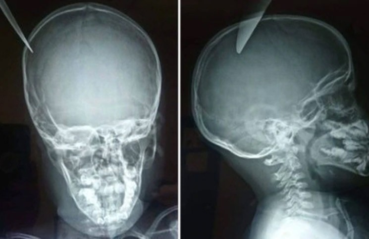 Estaban jugando y un nene le clavó un cuchillo en la cabeza a su amigo de 5 años | Curiosidades