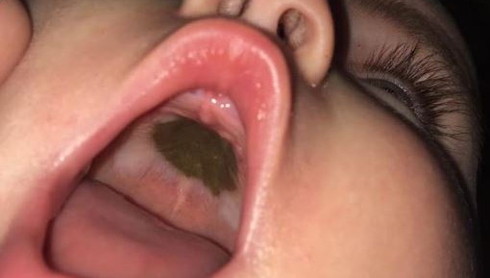 El crudo relato de la mujer que descubrió una mancha marrón en el paladar de su bebé | Curiosidades