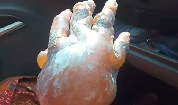 Un doctor advirtió sobre el peligro de usar pasta dental en caso de una quemadura | Internacionales