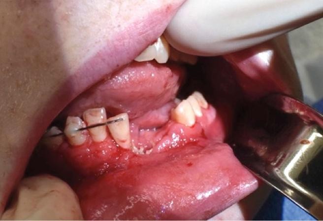 Le explotó un cigarrillo electrónico en la boca: perdió dientes y se fracturó la mandíbula | Curiosidades