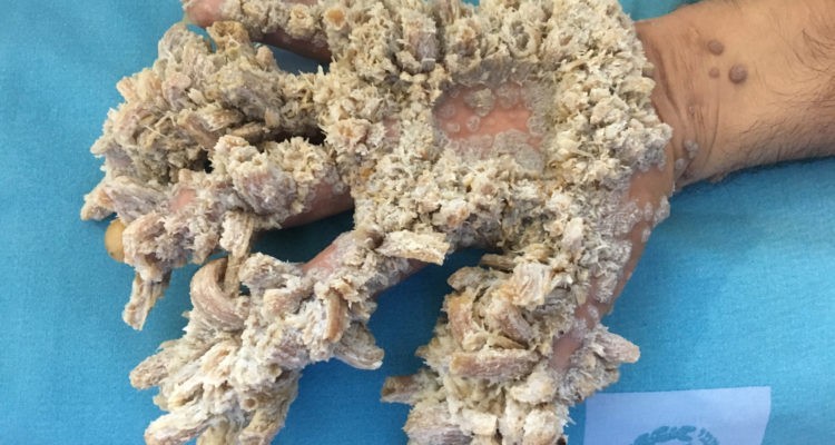 El drama del otro "hombre árbol" que lucha por curarse | Internacionales