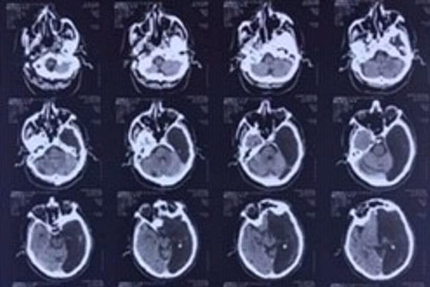 El ruso que vivió 60 años una "vida normal" con la mitad de su cerebro | Internacionales