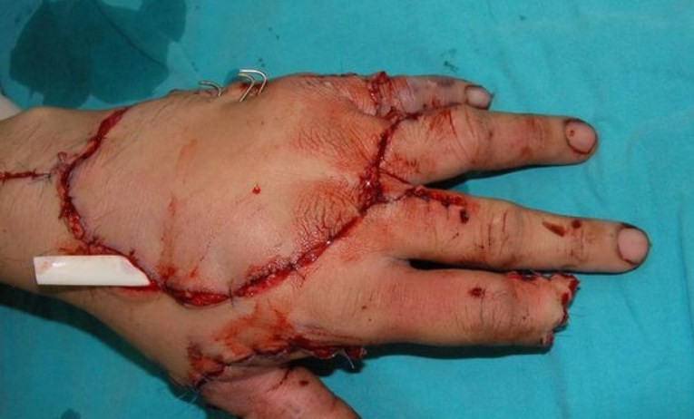 La increíble operación de un médico que reconstruyó una mano triturada | Internacionales
