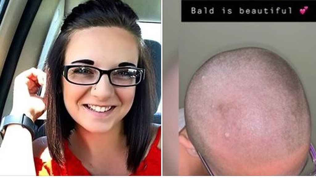 El drama de la joven que se le cayó el pelo tras usar un champú | Curiosidades