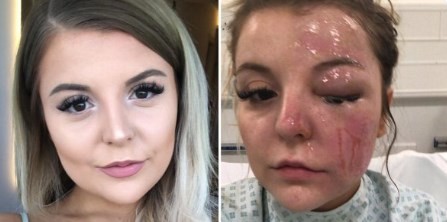 Hacía un huevo duro en el microondas, le explotó y así le quedó la cara | Curiosidades