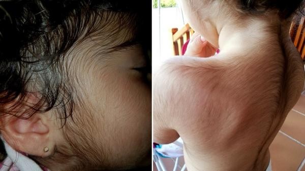 Chicos con "síndrome del hombre lobo": cerraron el laboratorio que vendió los medicamentos sospechosos | Internacionales