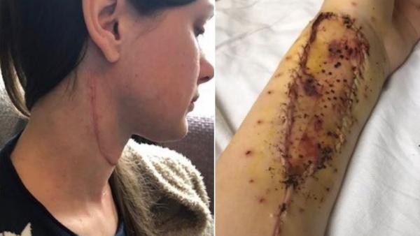 Reconstruyeron la lengua de una joven con parte del músculo de su brazo | Internacionales