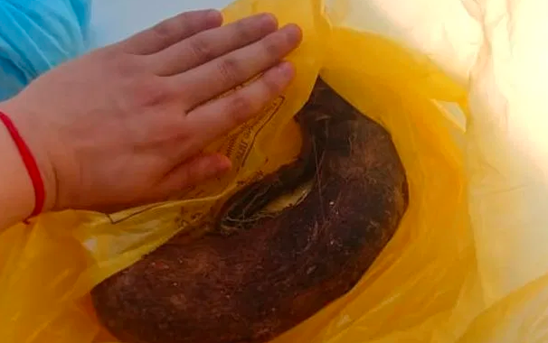 La joven a la que le sacaron casi dos kilos de pelo del estómago | Curiosidades