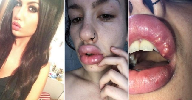 Era adicta a la cirugías estéticas y terminó con los labios llenos de pus | Curiosidades