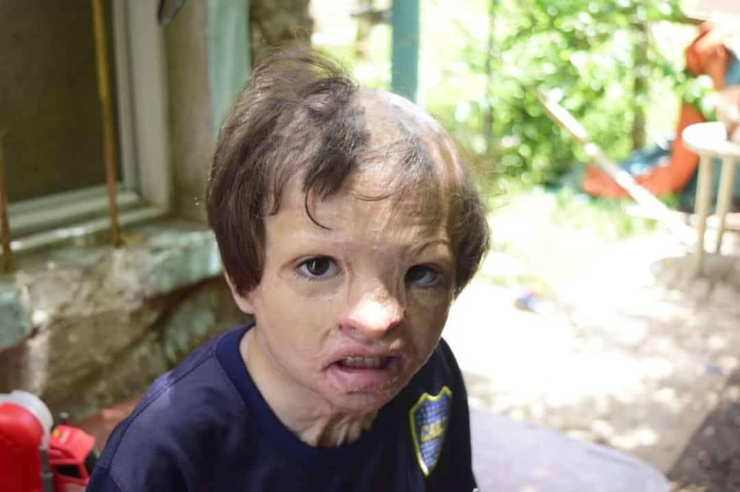 Un nene quemado en el incendio de su casa, a punto de ser desalojado | Actualidad