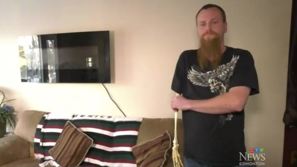 El hombre al que le amputaron un brazo por un accidente y conservó el esqueleto de recuerdo | Curiosidades