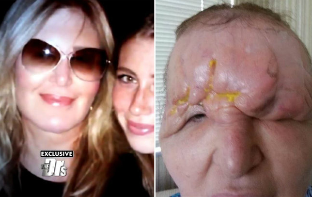 Una modelo quedó ciega y con la cara deformada tras inyectarse ácido hialurónico | Curiosidades