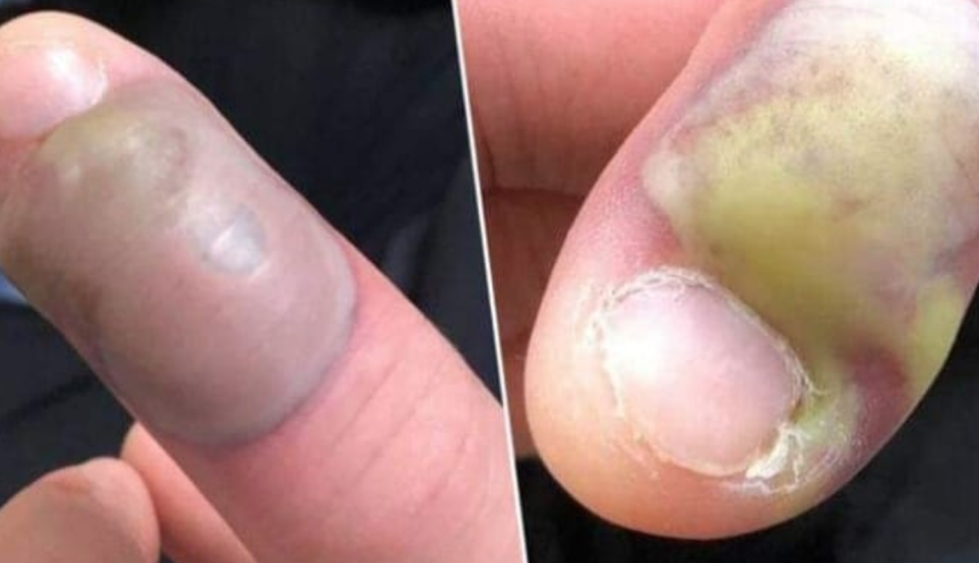 Imágenes impactantes: sufrió una grave infección por morderse las uñas | Curiosidades