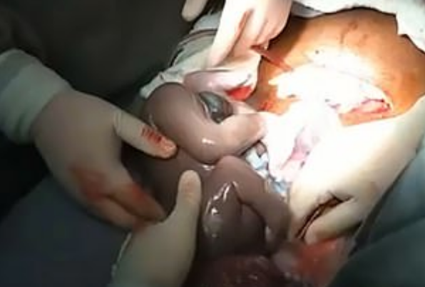 Video: el momento en el que un bebé nace dentro del saco amniótico | Curiosidades