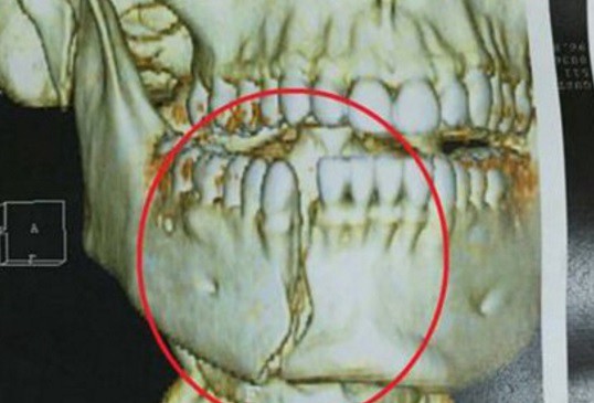 Brasil: así quedó la mandíbula del policía herido por rugbiers argentinos | Actualidad