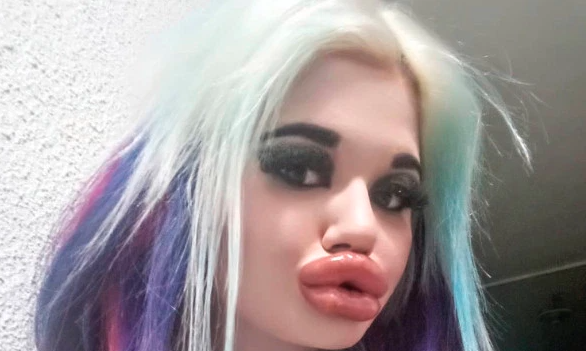 La joven que se dio 20 inyecciones para tener los labios más grandes del mundo | Curiosidades