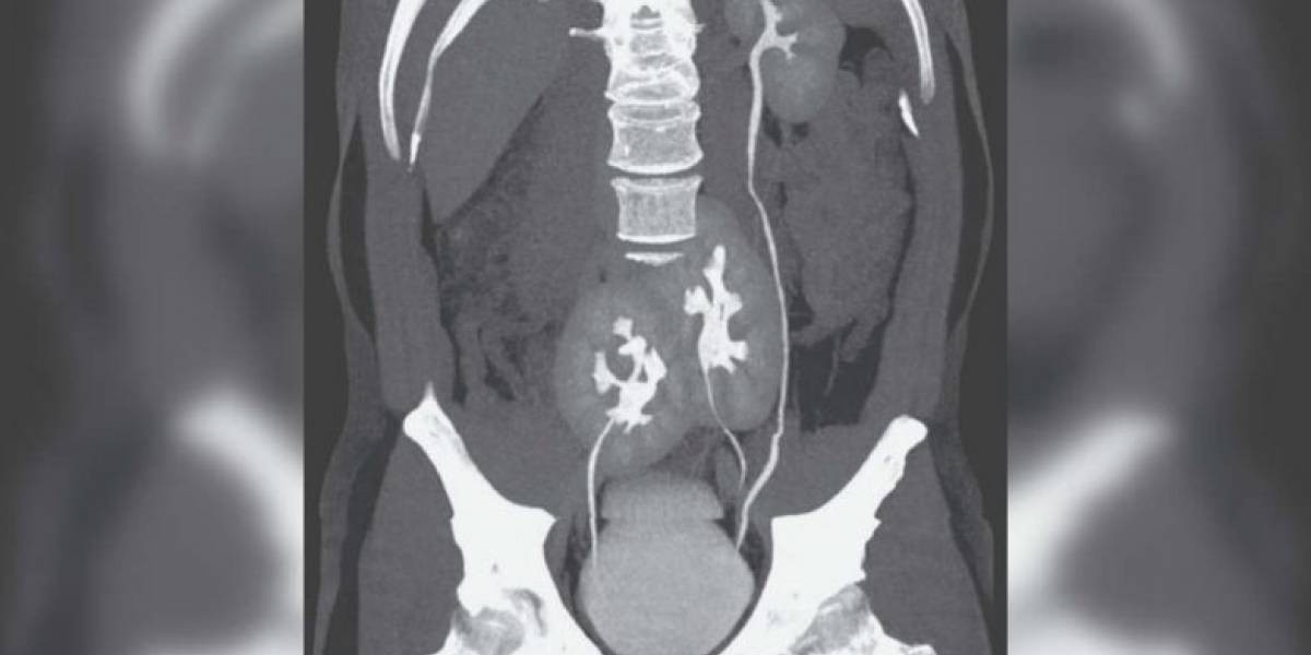 Fue al hospital por un dolor de espalda y descubrieron que tenía tres riñones | Curiosidades