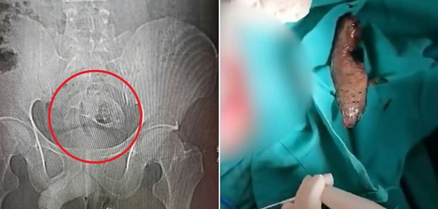 Operaron a un hombre para sacarle un pez del recto | Curiosidades