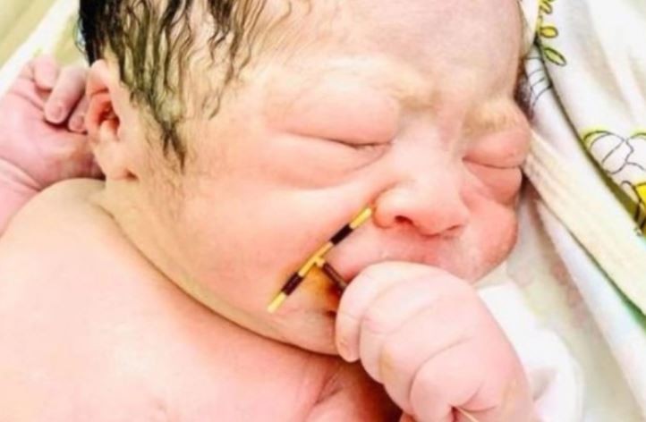 Un bebé nació con el DIU de su madre en la mano | Curiosidades