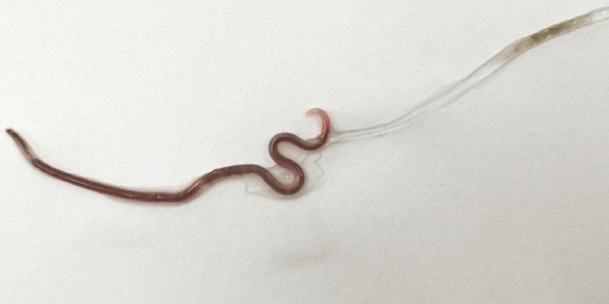 Comió sashimi en mal estado y le creció un gusano en la garganta | Curiosidades