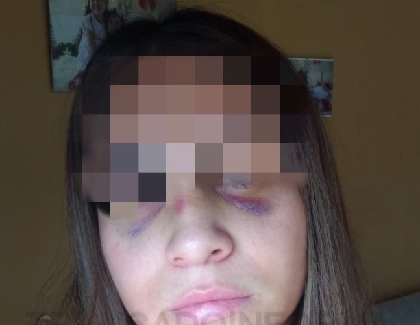 Un policía de Pico Truncado golpeó a su novia y le causó una triple fractura nasal | Actualidad