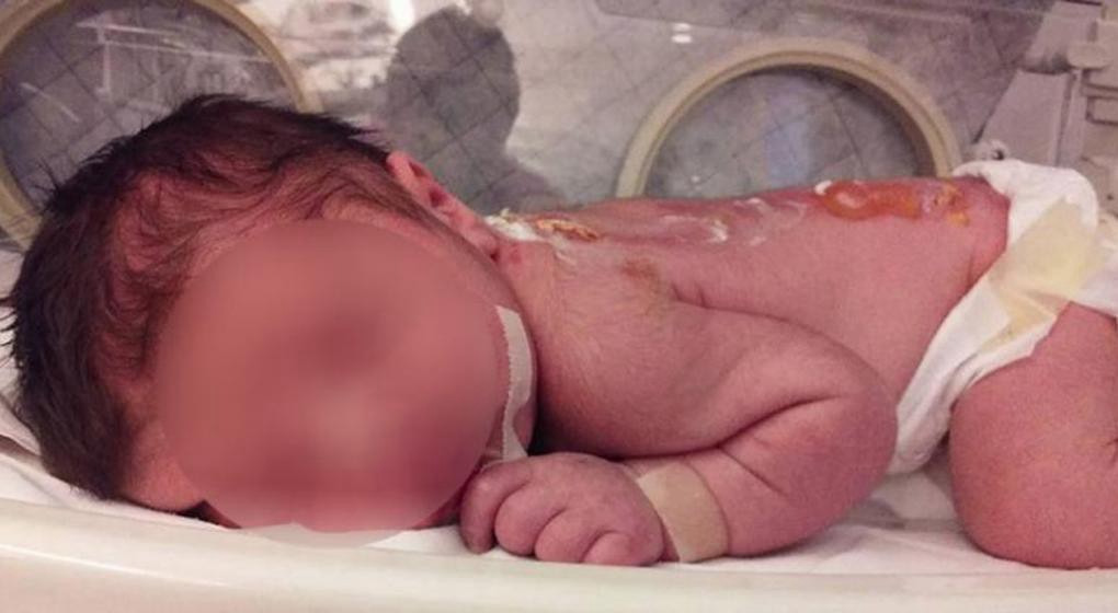 Córdoba: Bebé recién nacido sufrió quemaduras en una clínica | Actualidad