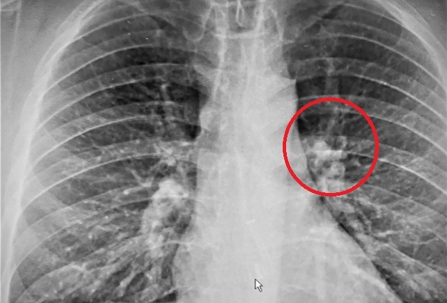 Se enteró por la radiografía que se había tragado un auricular mientras dormía | Internacionales