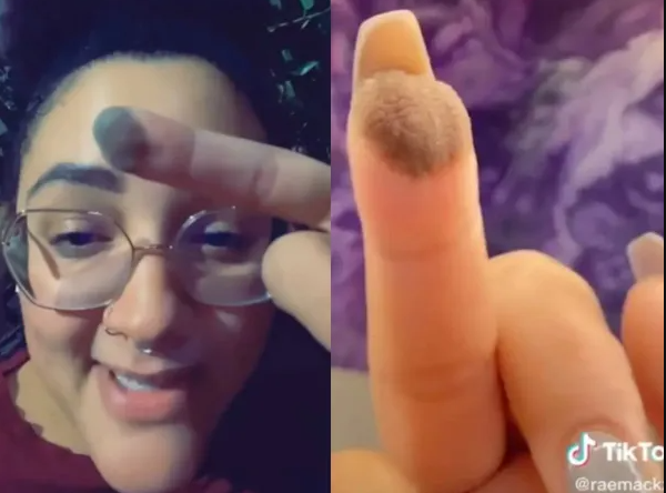 El extraño caso de una mujer que le crece vello púbico en un dedo a causa de un injerto de piel | Curiosidades