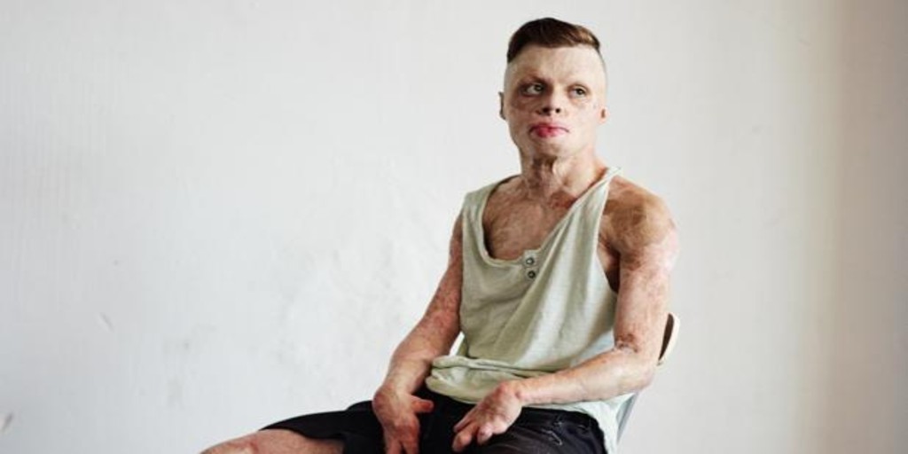 El calvario del "niño de fuego", el joven que sobrevivió tras quemarse el 90% del cuerpo | Internacionales