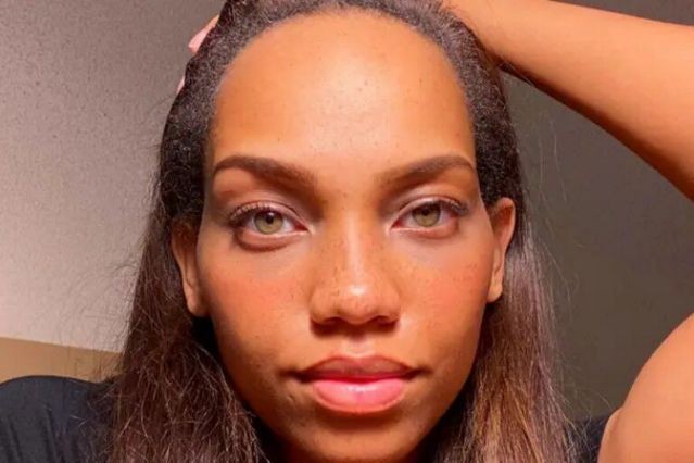 Una joven modelo gastó 7.000 dólares para reducir el tamaño de su frente | Internacionales