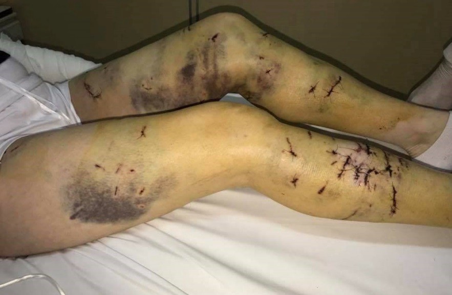 Alerta en Ushuahia: una jauría de perros salvajes atacó brutalmente a una mujer | Actualidad