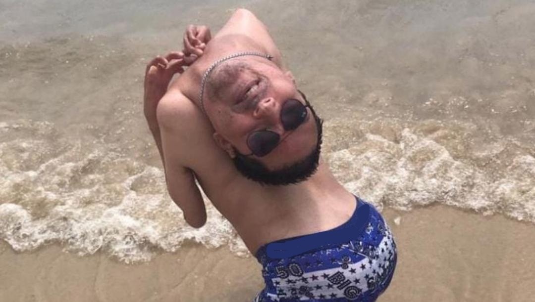 El hombre que nació con la cabeza al revés se contagió de coronavirus | Internacionales