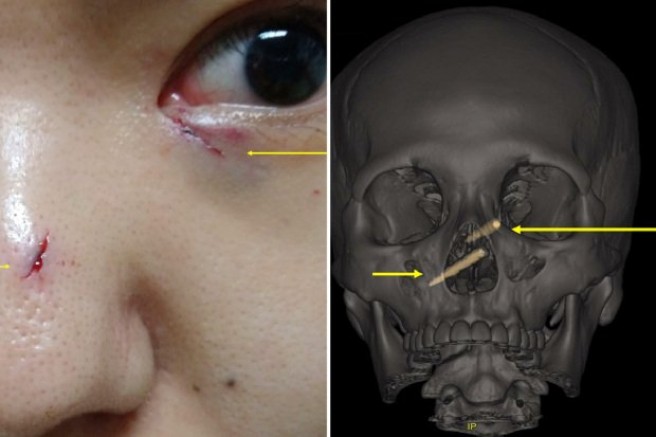 Una mujer pasó una semana con palillos de plástico en el cráneo casi sin darse cuenta | Internacionales