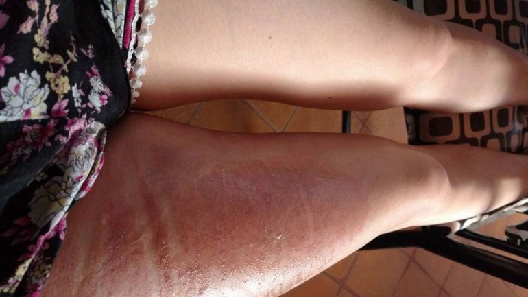 Una chica se quemó la piel con el líquido de la funda de su celular | Actualidad