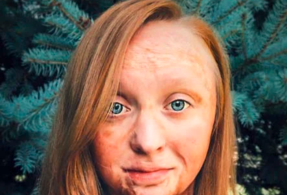 Su mamá intentó sacarle los piojos con nafta, se prendió fuego y estuvo a punto de morir quemada | Internacionales