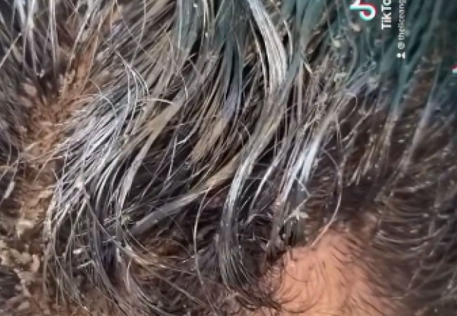 Video escalofriante: la nena que tuvo que ir al hospital porque tenía 15.000 piojos en la cabeza | Internacionales