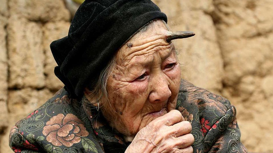La historia de la mujer de 101 años a la que le salió un cuerno en la frente | Internacionales