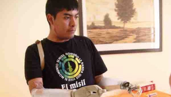Implantan brazos "mecánicos" a un joven jujeño | Tecno