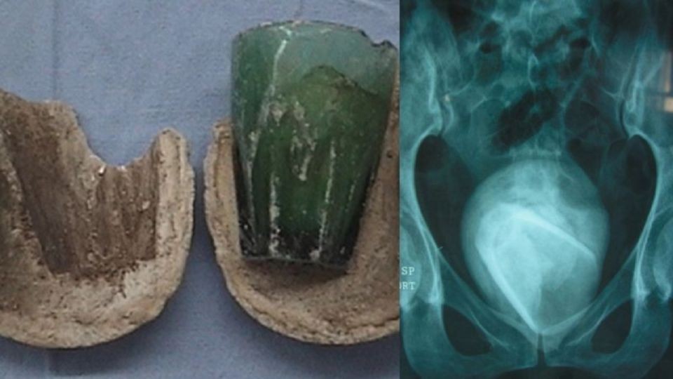 Fue al médico pensando que tenía una infección urinaria y le hallaron un vaso en la vejiga: lo usó como juguete sexual | Internacionales