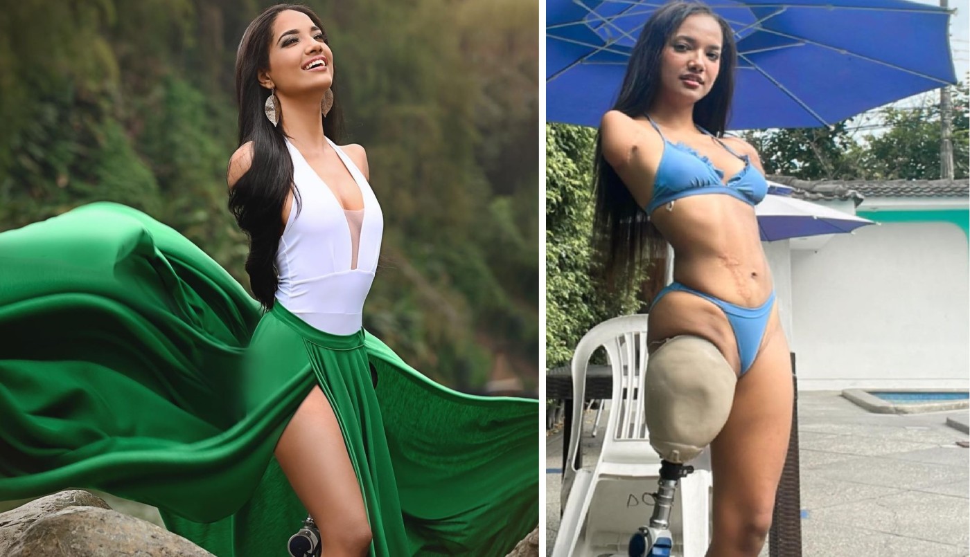 Perdió tres extremidades, se convirtió en modelo y no se deja afectar por los comentarios negativos | Internacionales