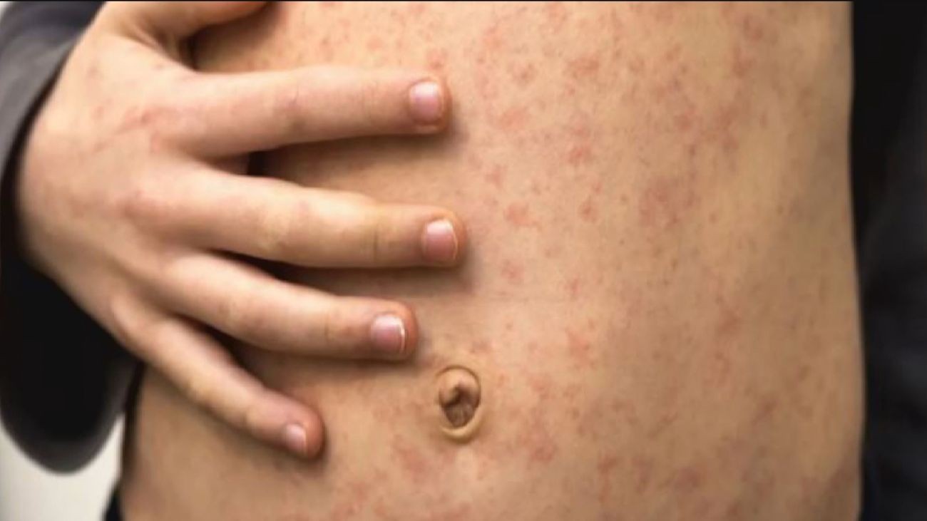 Viruela del mono: confirman a la primera mujer contagiada | Internacionales