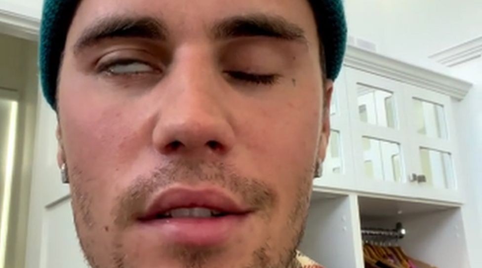 Justin Bieber con parálisis facial provocada por un virus | Espectáculos