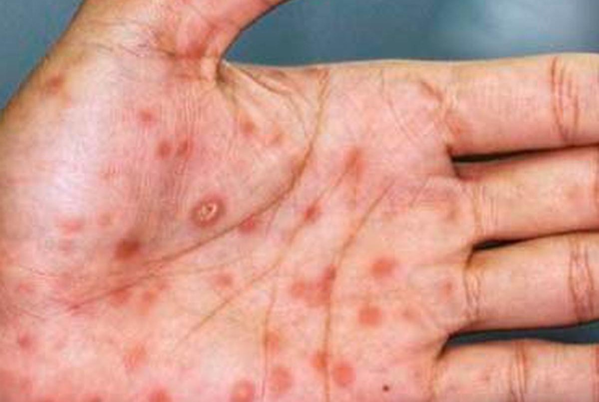 Reino Unido: quieren vacunar contra la viruela del mono a gays "de riesgo" | Internacionales