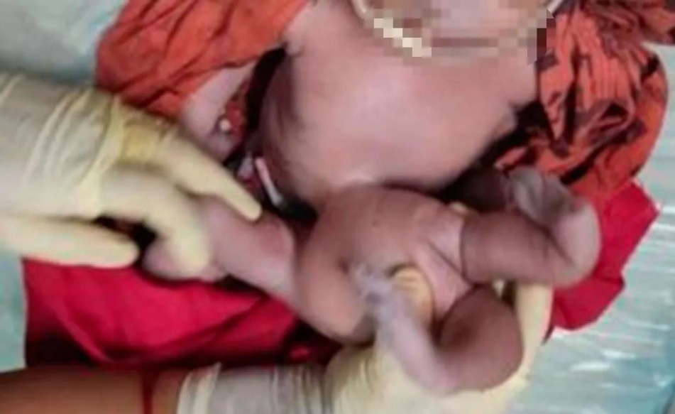 "Reencarnación de Dios": nació un bebé con cuatro brazos y cuatro piernas | Internacionales